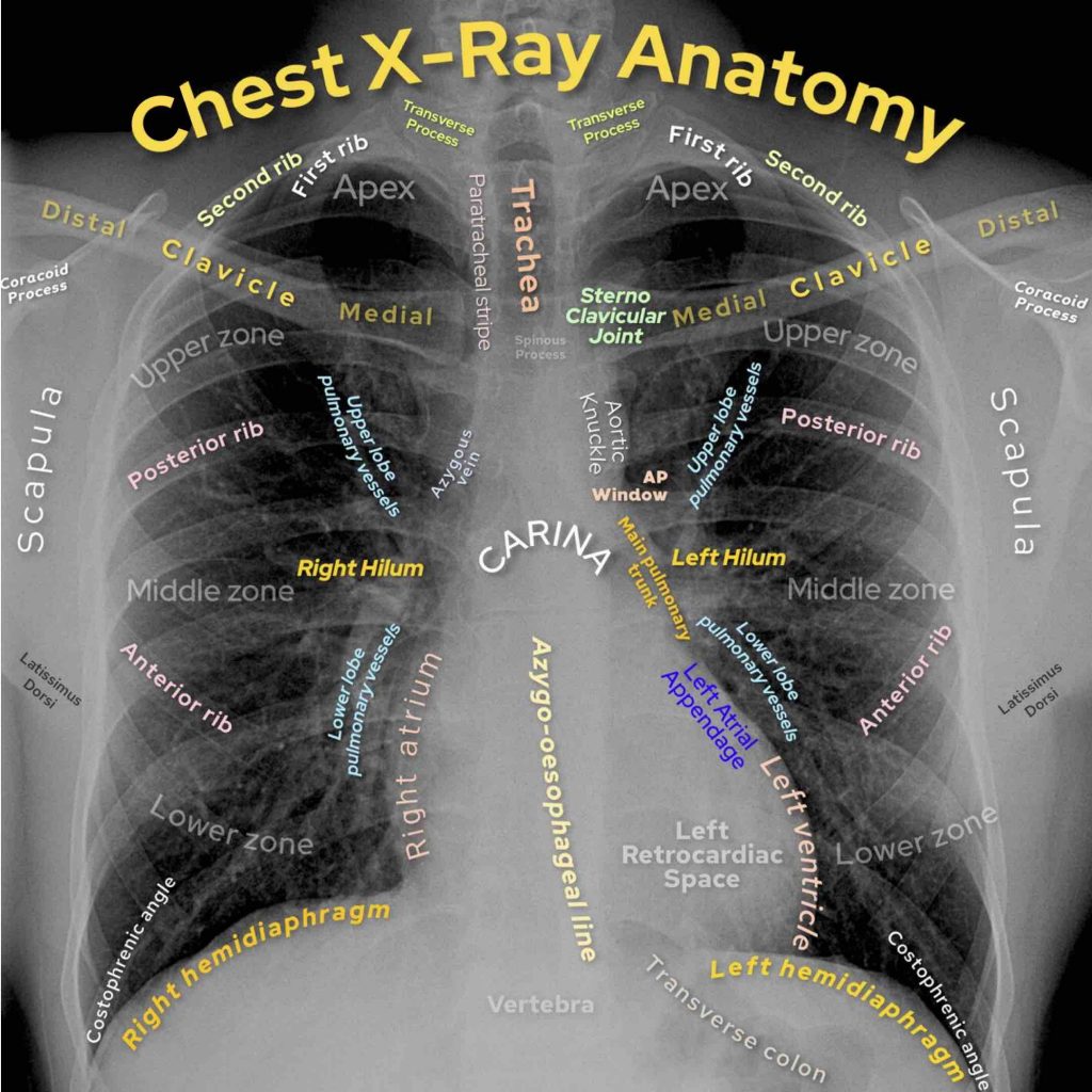 Normal Chest X-Ray Anatomy