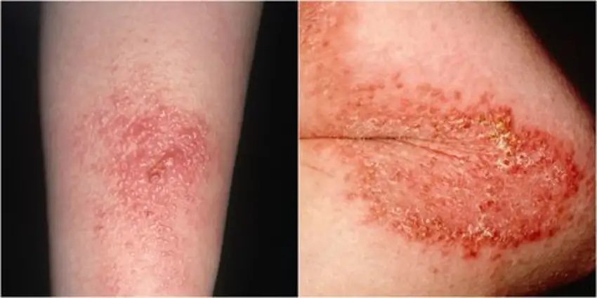 Poison Ivy Rash