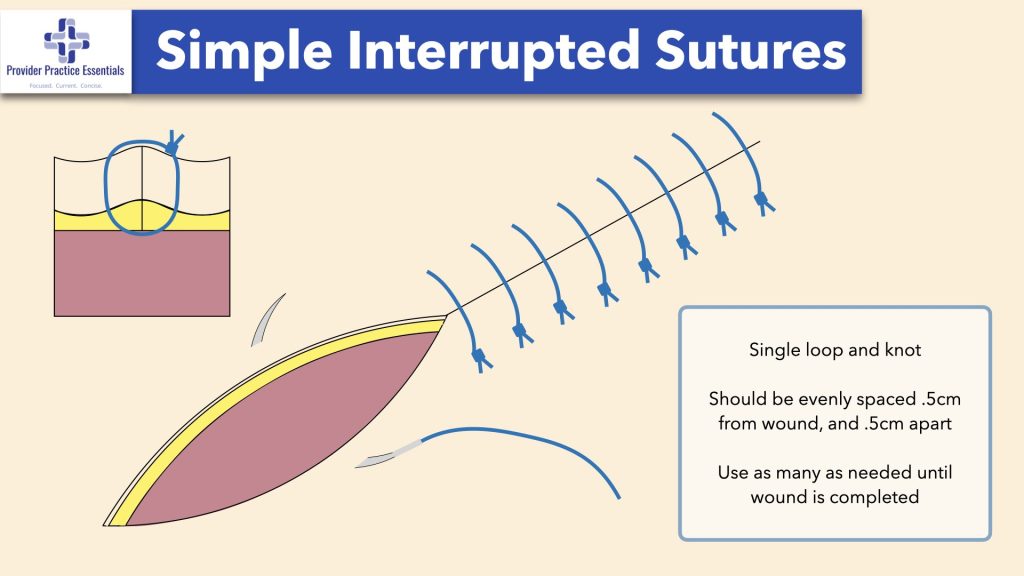 Simple Interrupted Sutures
