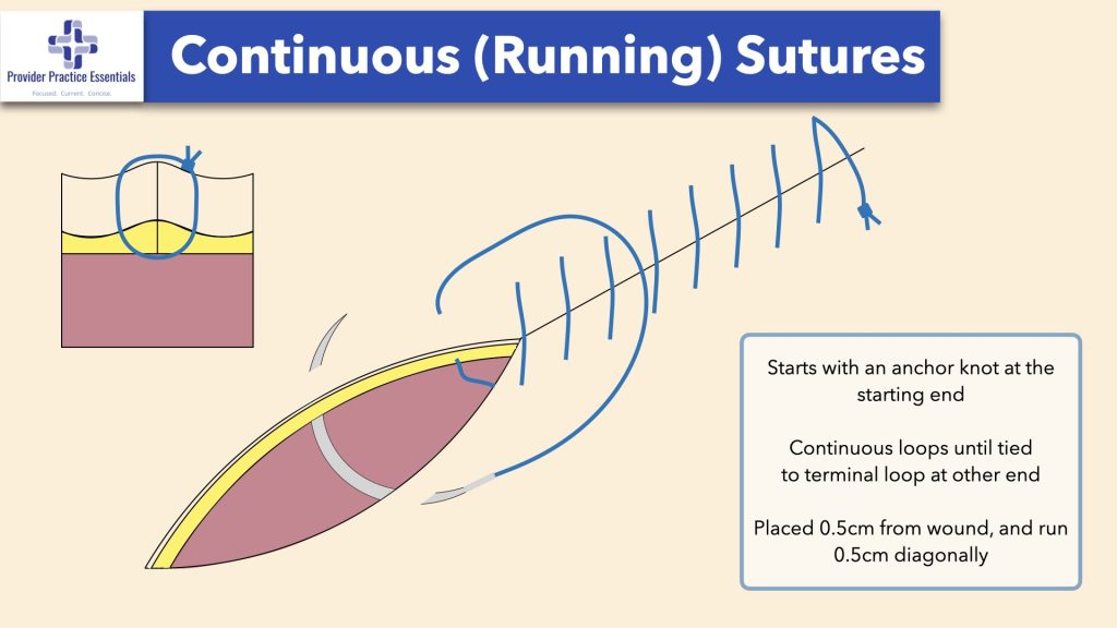 Continuous Sutures