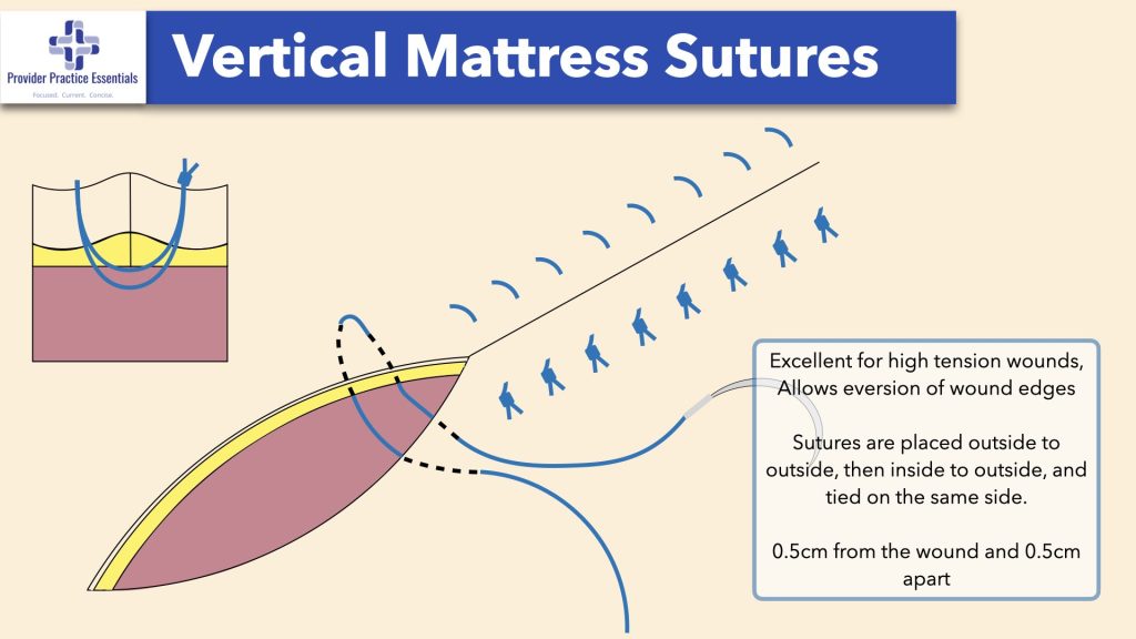Vertical Mattress Sutures
