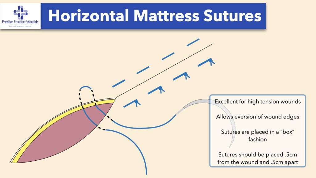 Horizontal Mattress Sutures