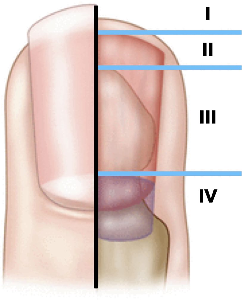 Types of fingertip avulsion